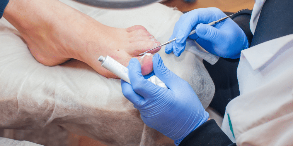 What To Expect: A Step-by-Step Guide To Laser Toenail Fungus Treatment ...