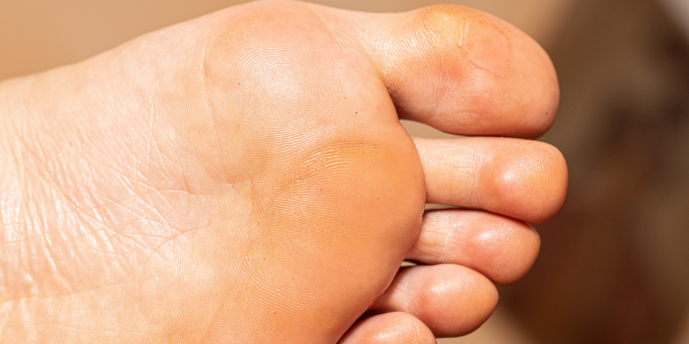 plantar warts